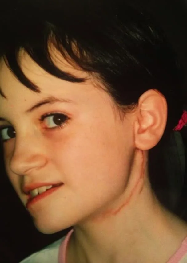 Jordan Surgery Scar